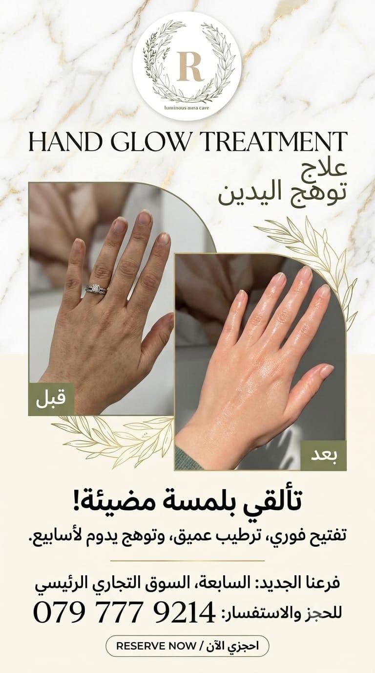 علاج توهج اليدين قبل وبعد
